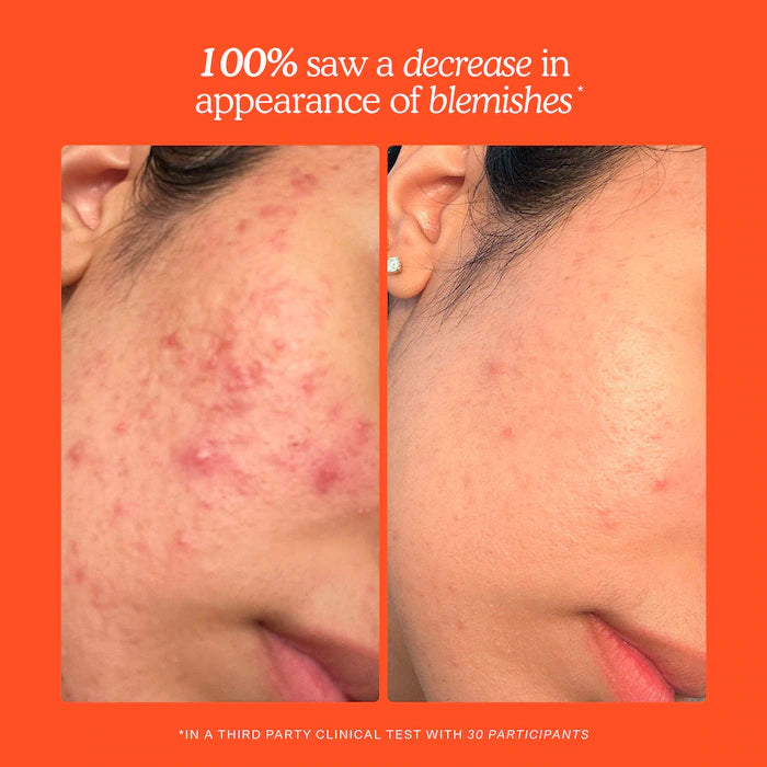 SOS Daily Hypochlorous Acid Spray para Breakouts & Redness de Tower 28