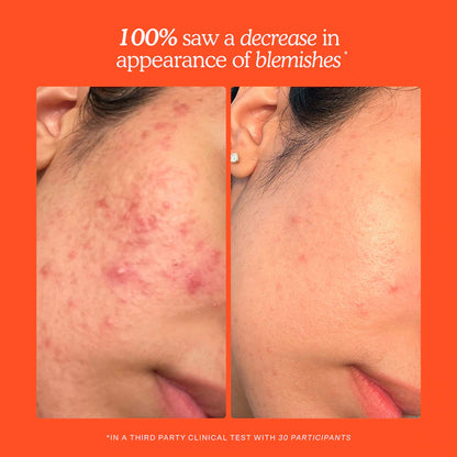 SOS Daily Hypochlorous Acid Spray para Breakouts & Redness de Tower 28