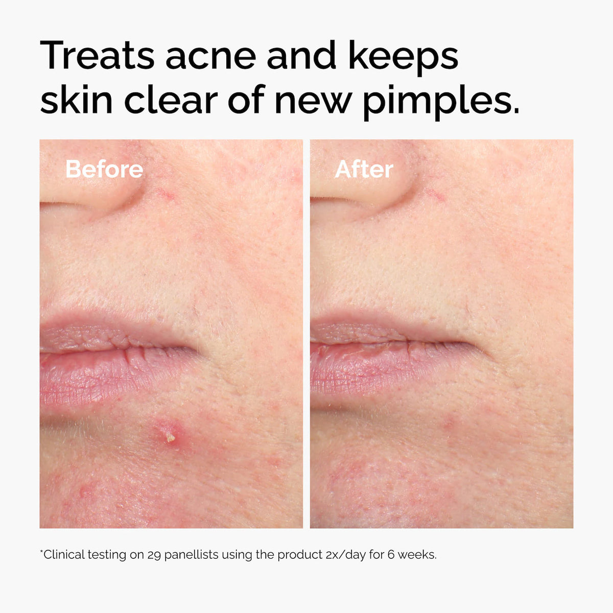 The Ordinary Salicylic Acid 2% Solution